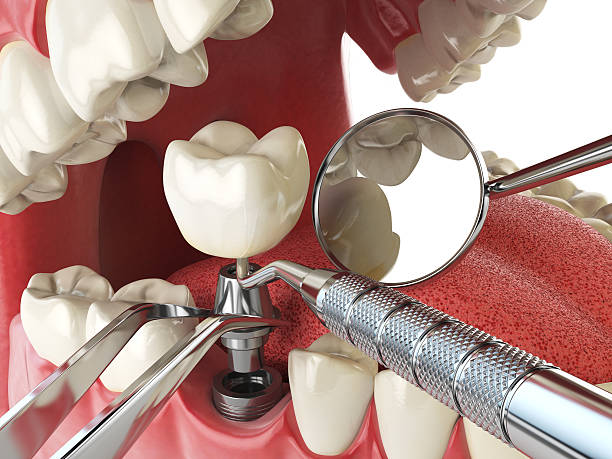 Best Knocked-Out Tooth (Avulsed Tooth) Treatment in Keaau, HI
